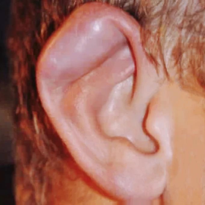 耳朵撕裂？好疼...武汉民生耳鼻喉医院紧急救治让耳朵恢复如初！