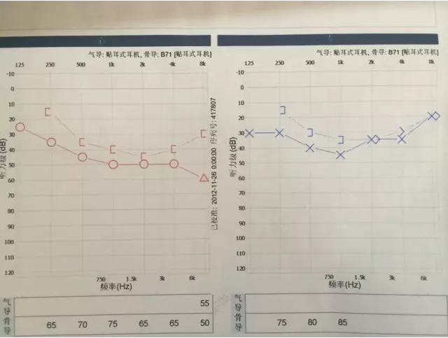 术前听力测试:左耳40 右耳50