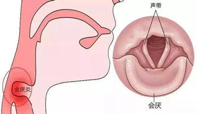 会厌谷梨状窝图片